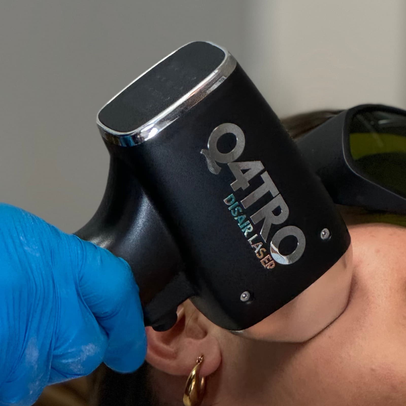 Manípulo Q4TRO de Disair Laser sobre la mejilla, con gafas de protección, en una sesión de depilación láser facial — Bodyfree Panamá
